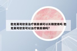 他克莫司软膏治疗银屑病可以长期使用吗 他克莫司软膏可以治疗银屑病吗?