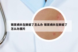 银屑病长在脚底了怎么办 银屑病长在脚底了怎么办图片