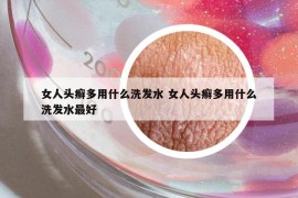 女人头癣多用什么洗发水 女人头癣多用什么洗发水最好