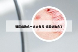 银屑病治愈一定会复发 银屑病治愈了