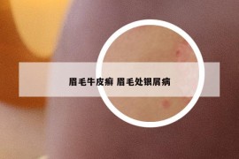 眉毛牛皮癣 眉毛处银屑病