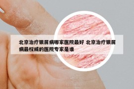 北京治疗银屑病哪家医院最好 北京治疗银屑病最权威的医院专家是谁