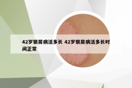 42岁银屑病活多长 42岁银屑病活多长时间正常