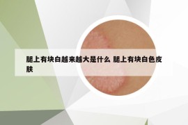 腿上有块白越来越大是什么 腿上有块白色皮肤