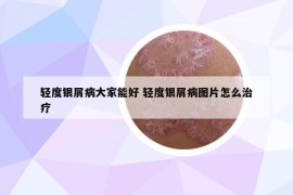 轻度银屑病大家能好 轻度银屑病图片怎么治疗