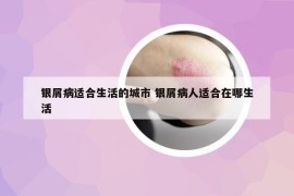 银屑病适合生活的城市 银屑病人适合在哪生活