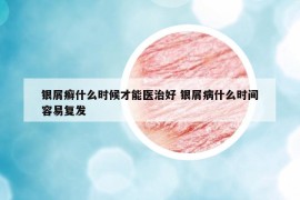 银屑癣什么时候才能医治好 银屑病什么时间容易复发