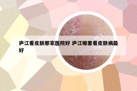 庐江看皮肤那家医院好 庐江哪里看皮肤病最好