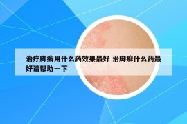 治疗脚癣用什么药效果最好 治脚癣什么药最好请帮助一下