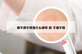 癣不痒不疼是什么癣呀 藓 不痛不痒