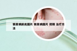 银屑病前兆图片 银屑病图片 初期 治疗方法