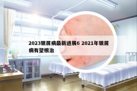 2023银屑病最新进展6 2021年银屑病有望根治