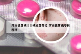 河南银屑病來問杨淑莲帮忙 河南银屑病专科医院