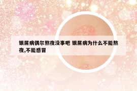 银屑病偶尔熬夜没事吧 银屑病为什么不能熬夜,不能感冒