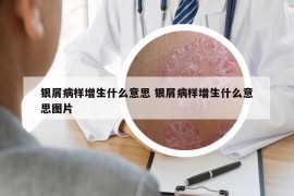 银屑病样增生什么意思 银屑病样增生什么意思图片