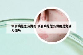 银屑病是怎么得的 银屑病是怎么得的是免疫力低吗