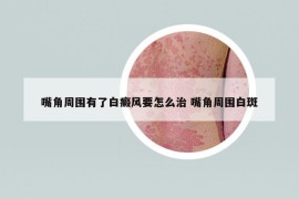 嘴角周围有了白癜风要怎么治 嘴角周围白斑