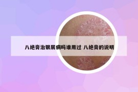 八绝膏治银屑病吗谁用过 八绝膏的说明