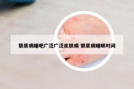 银屑病睡吧广泛广泛皮肤病 银屑病睡眠时间