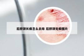 后脖颈长癣怎么去除 后脖颈处癣图片