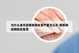 为什么来月经银屑病会变严重怎么办 银屑病经期前后复发