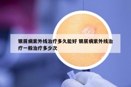 银屑病紫外线治疗多久能好 银屑病紫外线治疗一般治疗多少次