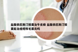 盐酸依匹斯汀胶囊治牛皮癣 盐酸依匹斯汀胶囊能治痤疮和毛囊炎吗