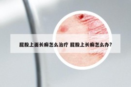 屁股上面长癣怎么治疗 屁股上长癣怎么办?