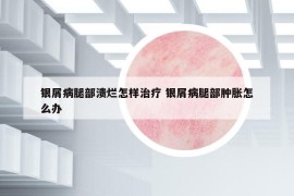 银屑病腿部溃烂怎样治疗 银屑病腿部肿胀怎么办