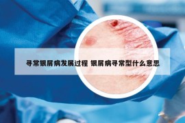 寻常银屑病发展过程 银屑病寻常型什么意思