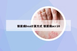 银屑病bsa计算方式 银屑病acr20