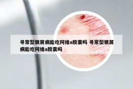 寻常型银屑病能吃阿维a胶囊吗 寻常型银屑病能吃阿维a胶囊吗