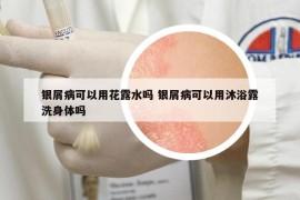 银屑病可以用花露水吗 银屑病可以用沐浴露洗身体吗