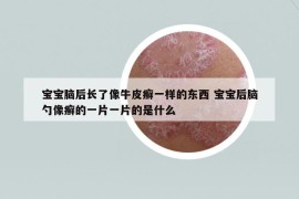 宝宝脑后长了像牛皮癣一样的东西 宝宝后脑勺像癣的一片一片的是什么