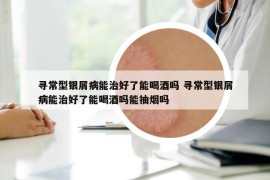 寻常型银屑病能治好了能喝酒吗 寻常型银屑病能治好了能喝酒吗能抽烟吗