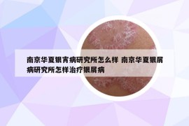 南京华夏银宵病研究所怎么样 南京华夏银屑病研究所怎样治疗银屑病