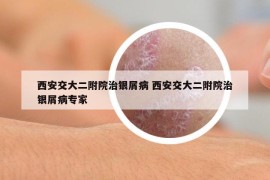 西安交大二附院治银屑病 西安交大二附院治银屑病专家