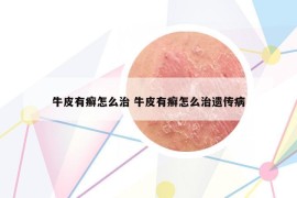 牛皮有癣怎么治 牛皮有癣怎么治遗传病