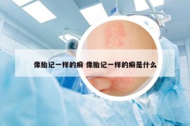 像胎记一样的癣 像胎记一样的癣是什么