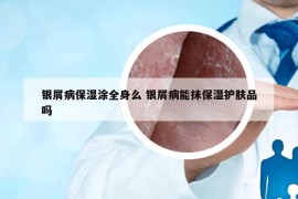 银屑病保湿涂全身么 银屑病能抹保湿护肤品吗