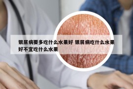 银屑病要多吃什么水果好 银屑病吃什么水果好不宜吃什么水果