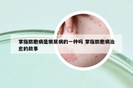 掌指脓胞病是银屑病的一种吗 掌指脓胞病治愈的故事