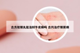 古方祛银丸能治好牛皮癣吗 古代治疗银屑病