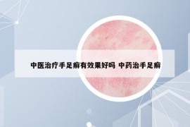 中医治疗手足癣有效果好吗 中药治手足癣