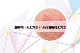 治癣有什么土方法 什么药治癣的土方法