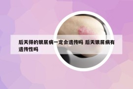 后天得的银屑病一定会遗传吗 后天银屑病有遗传性吗