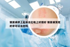 银屑病早上起床会比晚上好很好 银屑病发现的早可以治愈吗