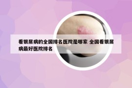 看银屑病的全国排名医院是哪家 全国看银屑病最好医院排名