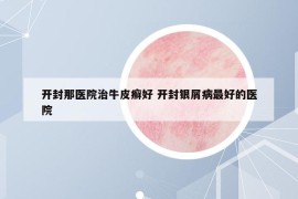 开封那医院治牛皮癣好 开封银屑病最好的医院