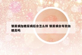 银屑病加糖尿病后会怎么样 银屑病会导致血糖高吗